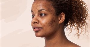 Different types of pigmentation and how to treat it