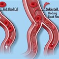 Normal blood cells (left) and the blood cells in sickle cell disease, which do not flow through the circulatory system smoothly. Credit: Darryl Leja, NHGRI (CC BY 2.0)