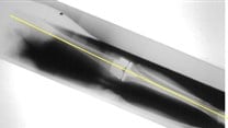An X-ray with yellow line illustrating neutral mechanical alignment.