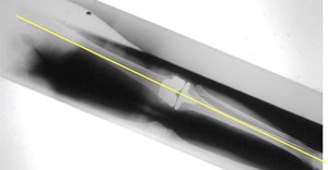 An X-ray with yellow line illustrating neutral mechanical alignment.