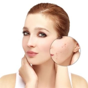 How Skin Renewal is clearing adult acne holistically