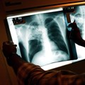 The WHO recommends that TB prevalence surveys be done in high burden countries. Spencer Platt/Getty Images
